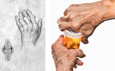 Ayurvedic Treatment Of Arthritis Painful Joints By Shashikant Patwardhan