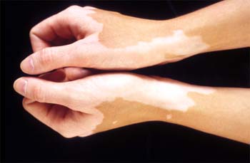 vitiligo - Leucoderma